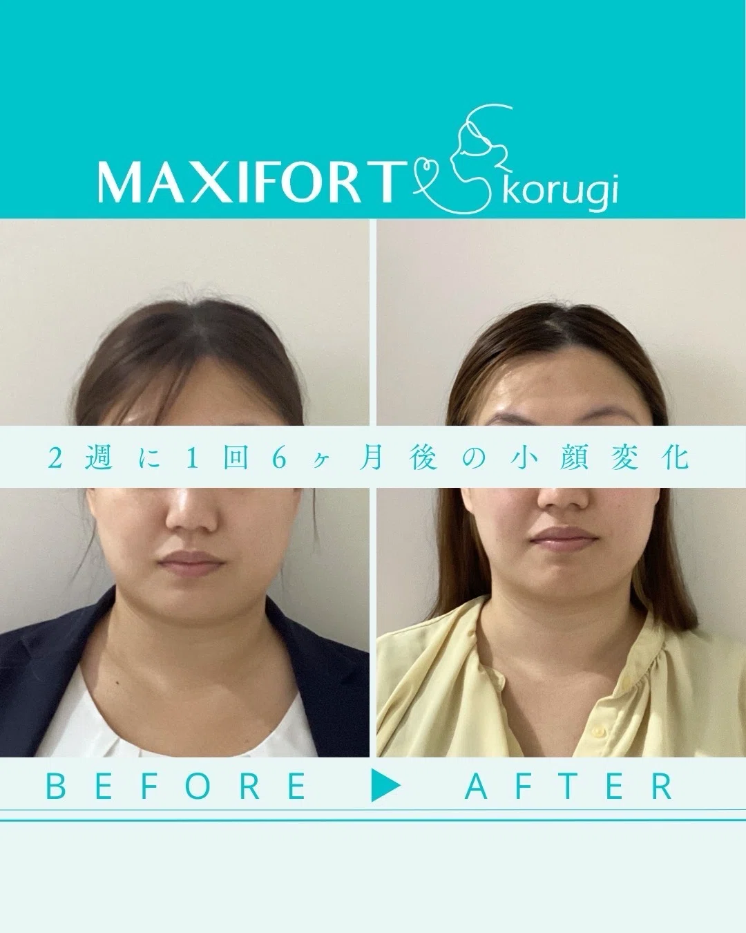【ここだけの話】韓国コルギのデメリット | 名古屋小顔サロン|マイナス5キロ顔屋さん〈MAXIFORT〉