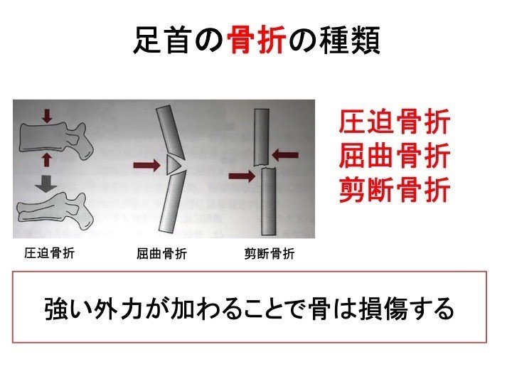 足首をひねった これは骨折 捻挫 骨折の現場判断について 岡野 良介 Note 足首をひねった これは骨折 捻挫 骨折の現場判断について 岡野 良介 Note