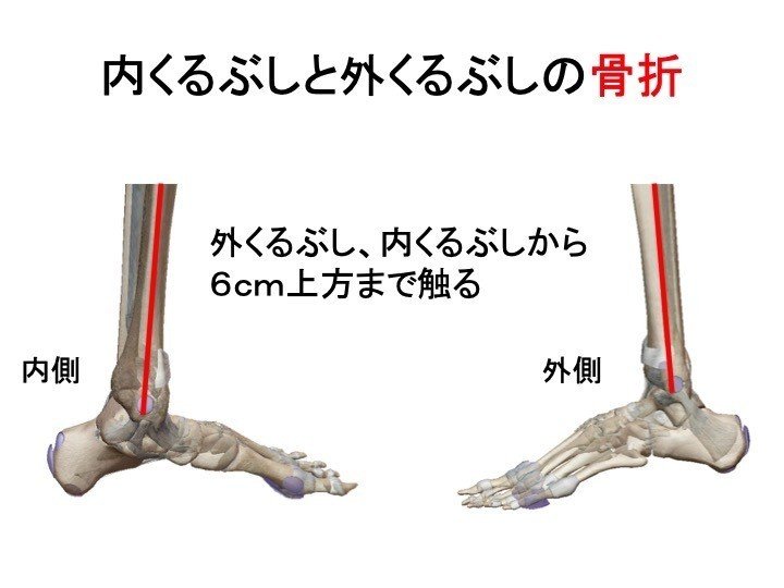 足首をひねった これは骨折 捻挫 骨折の現場判断について 岡野 良介 Note 足首をひねった これは骨折 捻挫 骨折の現場判断について 岡野 良介 Note