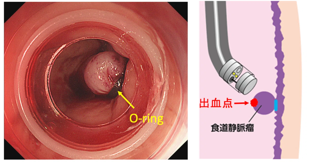 食道静脈瘤 内視鏡治療 ガイドライン _ IX 胃静脈瘡に対する内視鏡治療 – PIWZ