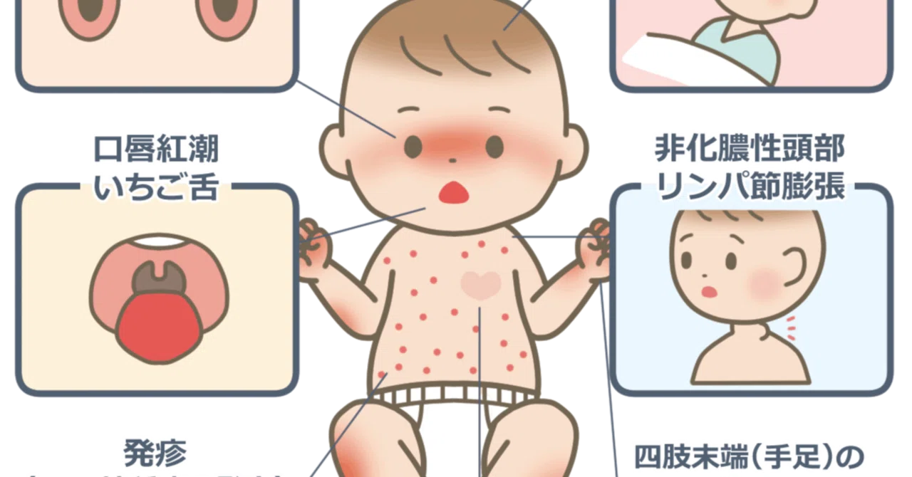 About Kawasaki Disease (Fever + Rash + Red Eyes and Mouth)｜小児科医れい