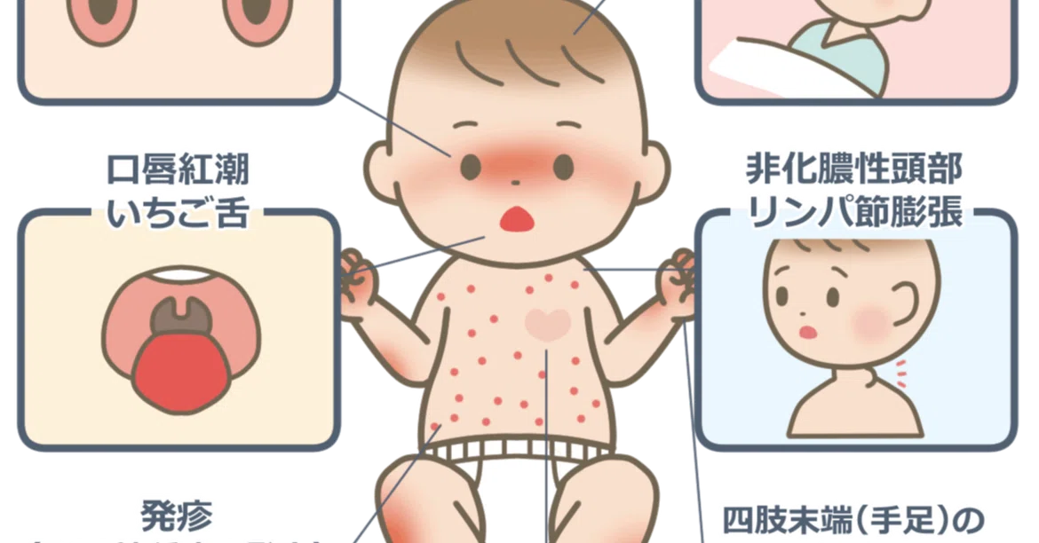 About Kawasaki Disease (Fever + Rash + Red Eyes and Mouth)｜小児科医れい
