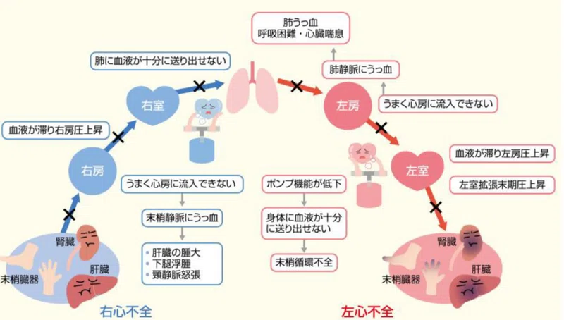 慢性心不全について|内部障害リハビリ