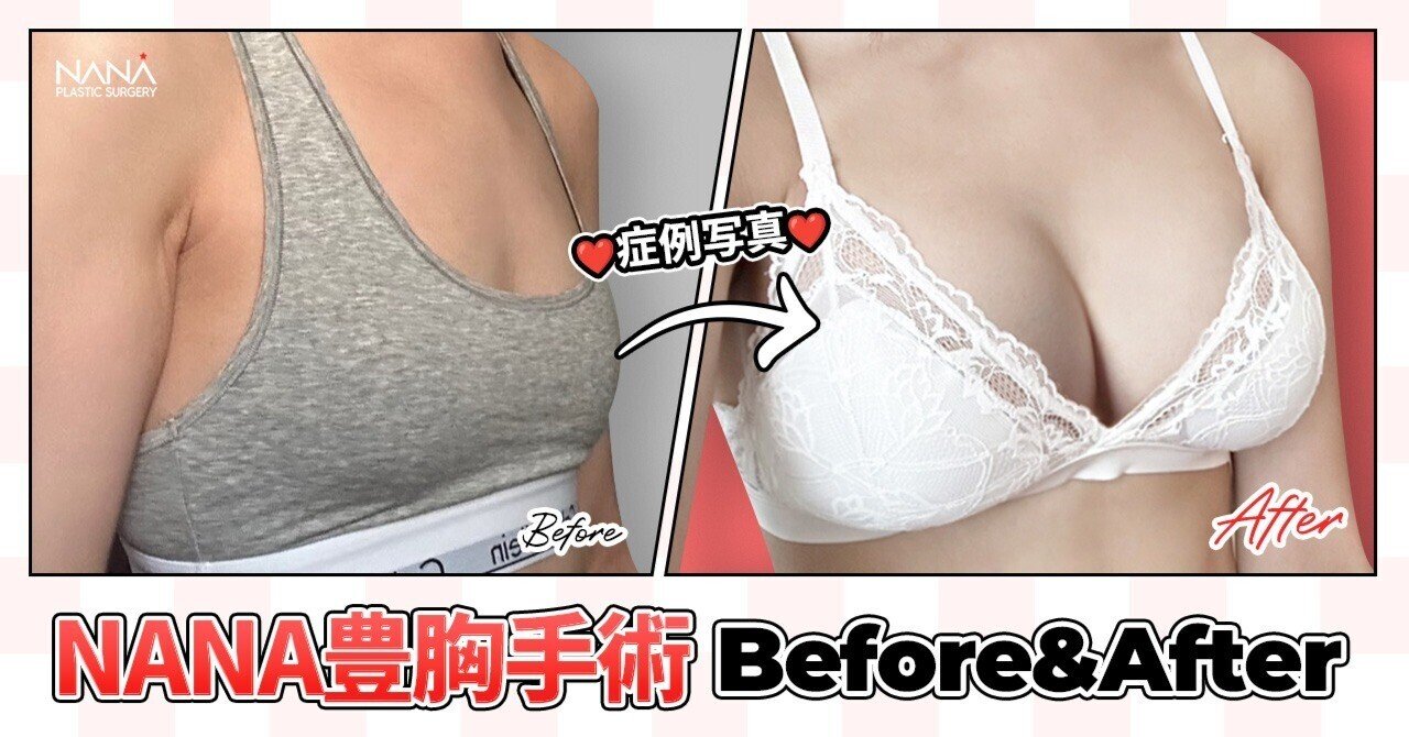 NANA豊胸手術⭐Before&After⭐症例写真｜韓国整形NANA美容外科