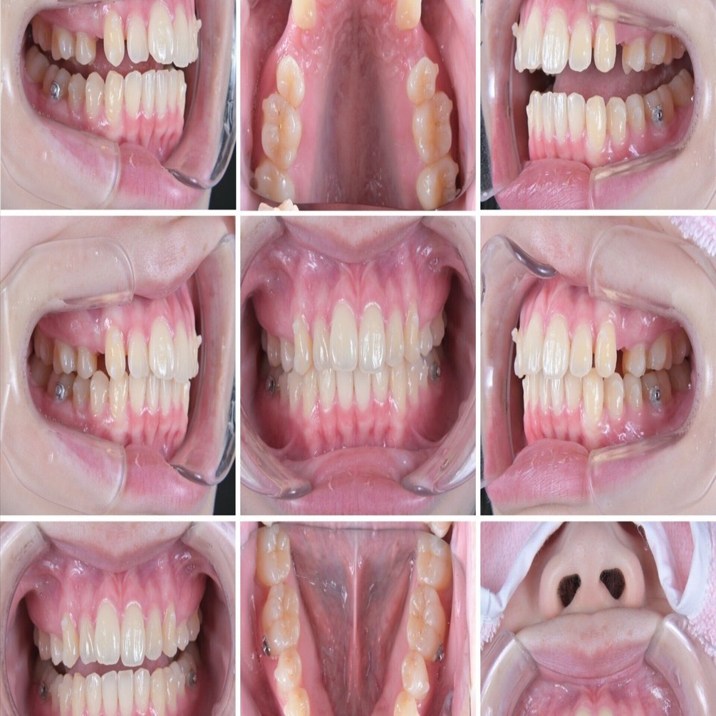 口腔内写真の撮り方｜5枚法(9枚法)の設定解説｜口腔内写真専門チャンネル