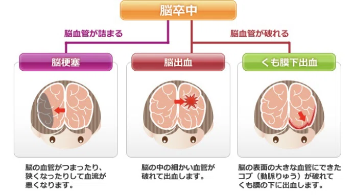 脳卒中、怖いです|みゃおん