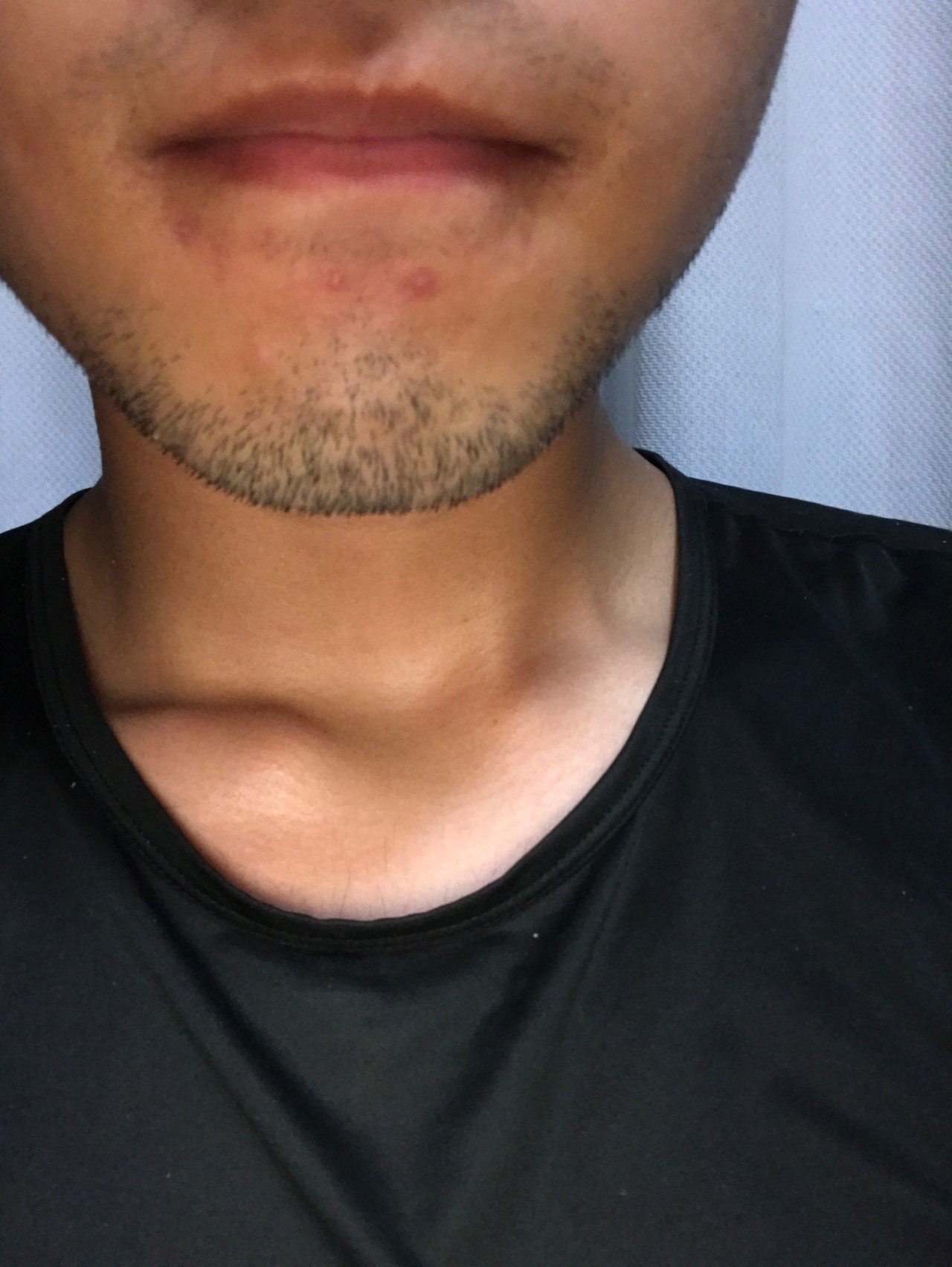 高校生男子の無精髭 Sack Zack Note