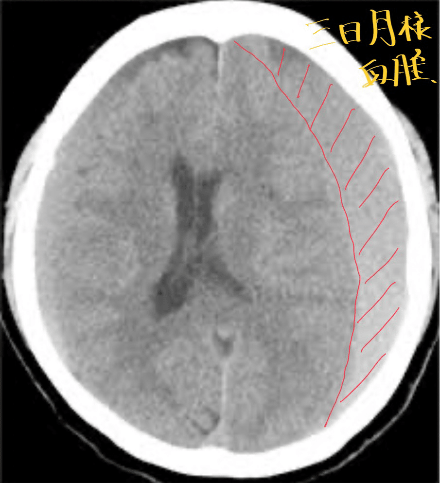 第59回理学療法士国家試験AM3問目｜ネクストリハアカデミー