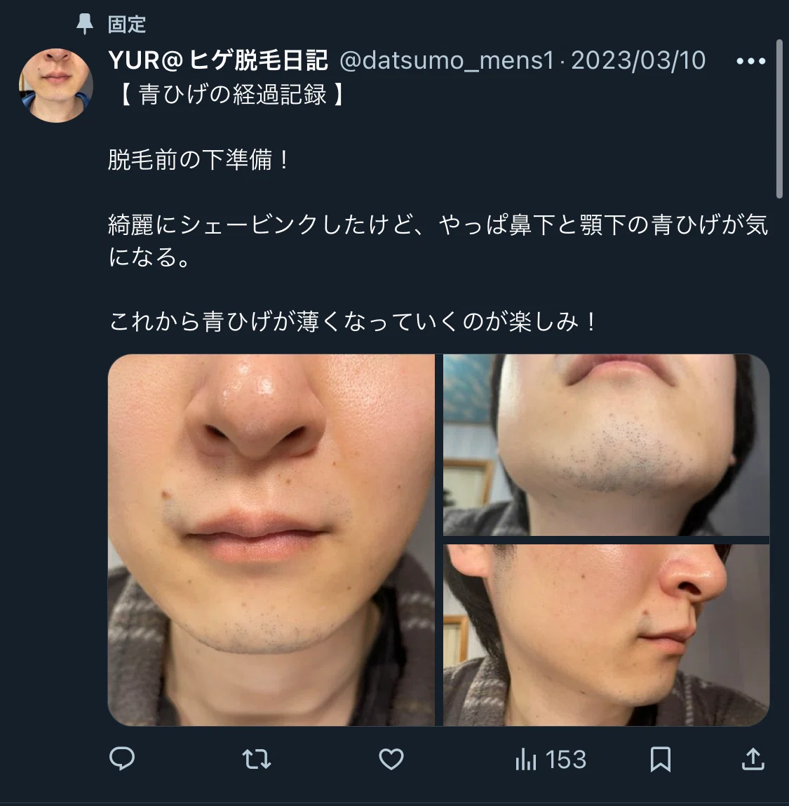 自己紹介「私がヒゲ脱毛の決意した理由」｜RYO＠メンズエミナルの体験日記