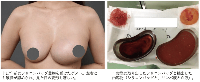 豊胸手術で失敗しないために知っておきたい5つの常識 シリコンバッグ編 Tc Liposuction Note 豊胸手術で失敗しないために知っておきたい5つの常識 シリコンバッグ編 Tc Liposuction Note