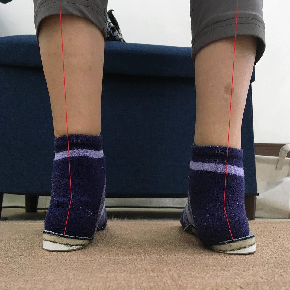 O脚の改善で絶対にやってはいけない事 こば Note