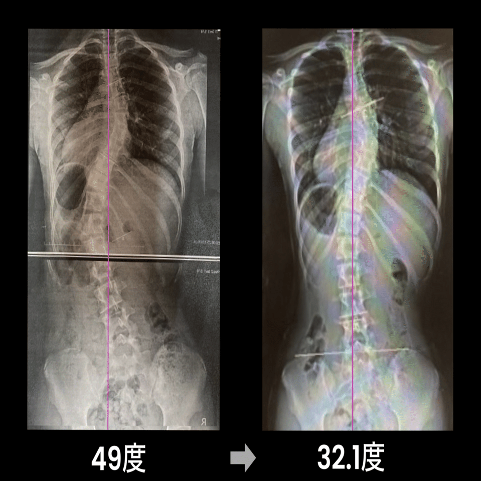 ご報告】49度➡︎32.1度へ11ヶ月で改善 | 側弯症改善ヨガ｜喜多貴子