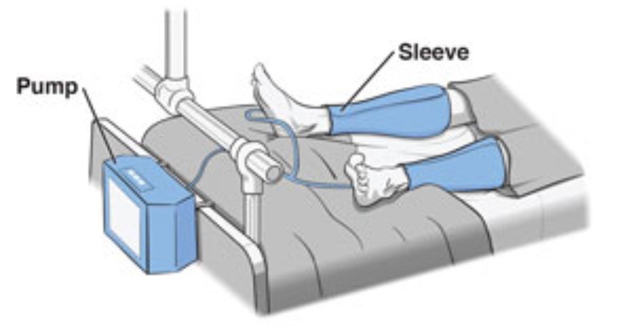 ＜文献紹介 第3弾：ICUでのDVT予防にフットポンプは必要なのか？！＞｜Yuki_Waka