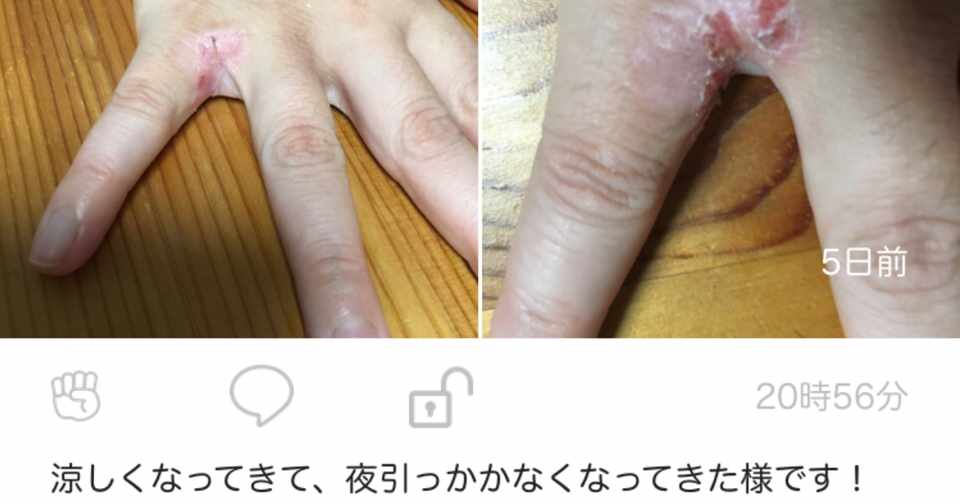 アトピー写真をアップし 仲間と共感しながら 皮膚科医にも見せられるアプリ アトピヨ Tech使う組 悩み 社会課題をテクノロジーで解決 Note