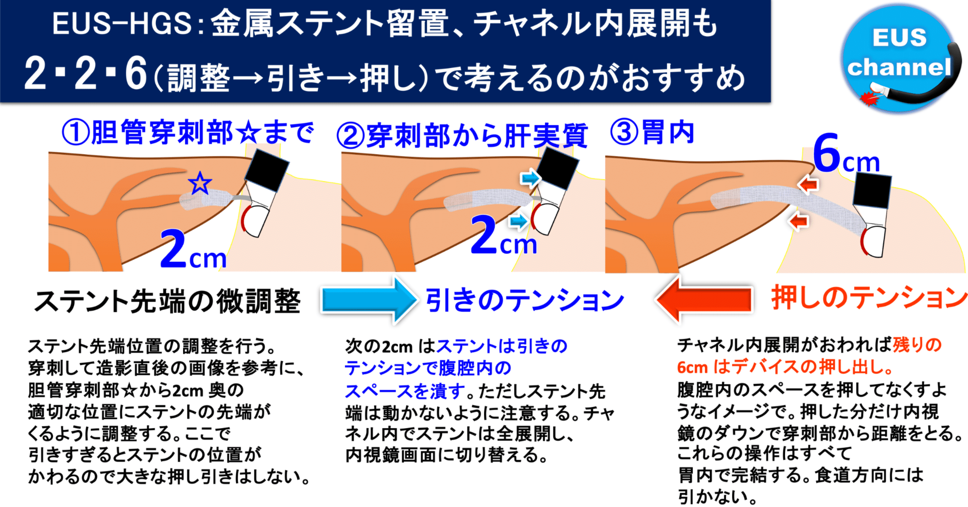 世界一やさしいHGS ~22G穿刺のデバイスと戦略について~｜shun