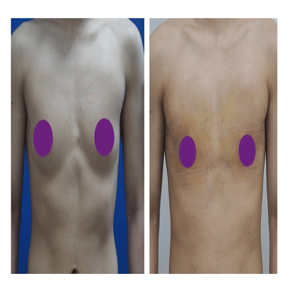 FTM胸オペ後の乳輪、乳首の傷かくし