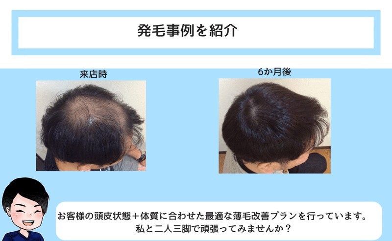 え！？つむじが薄い？気づいた時には、進行しているつむじハゲの原因と対策は？ (40)