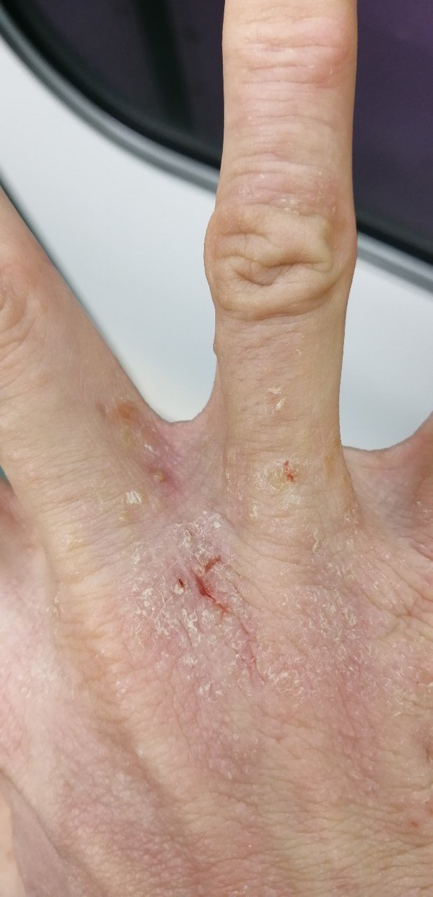 アトピー日記 95日目 だんだん良くなって来た 手の水痘がカサブタに アトピーマン Note アトピー日記 95日目 だんだん良くなって来た 手の水痘がカサブタに アトピーマン Note