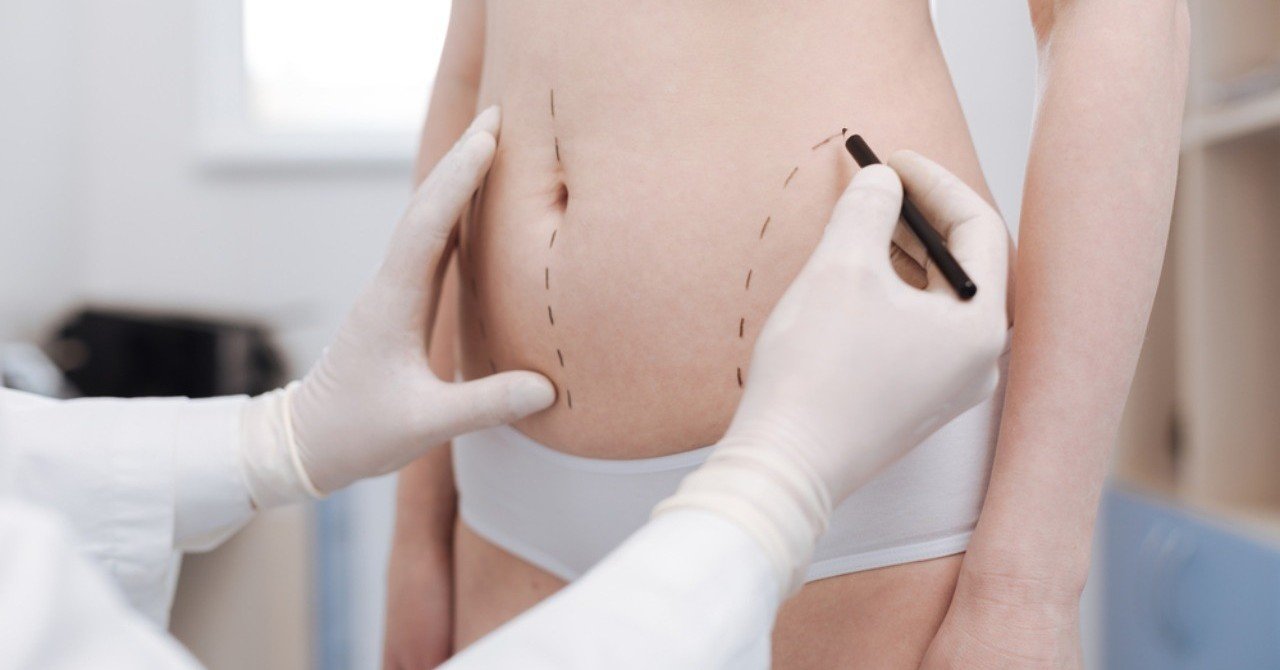 脂肪吸引の体験者たちに学ぶ 本当のところ どうなの O M モモ子 コレステローラー Note