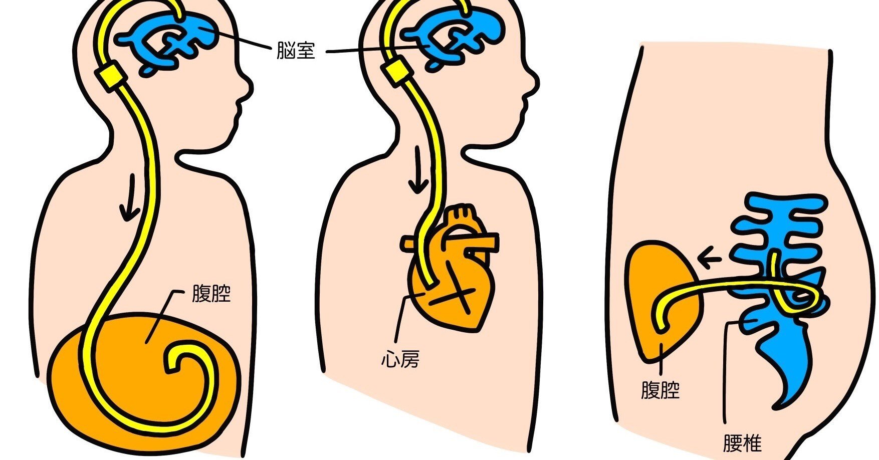 水頭症のひと 特発性正常圧水頭症（iNPH）。「手術で改善できる認知症」。主な