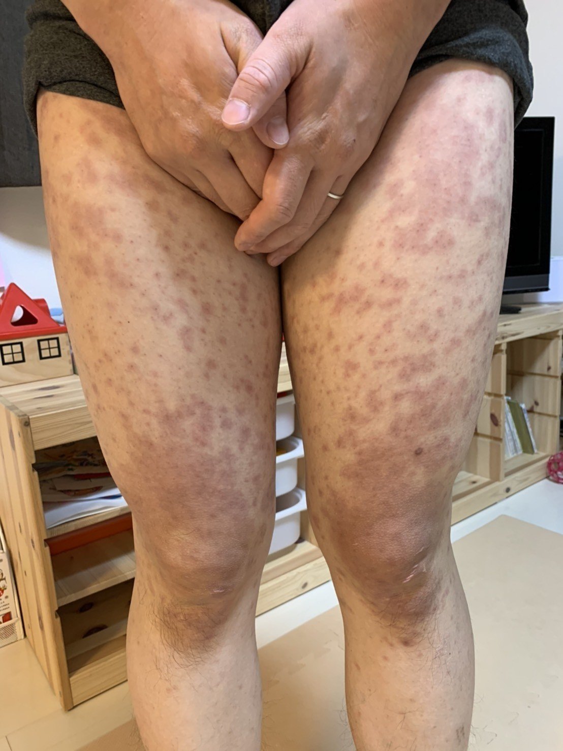 ピロリ菌除菌のアレルギー反応（薬疹）で死にかけたけど、後悔せず 