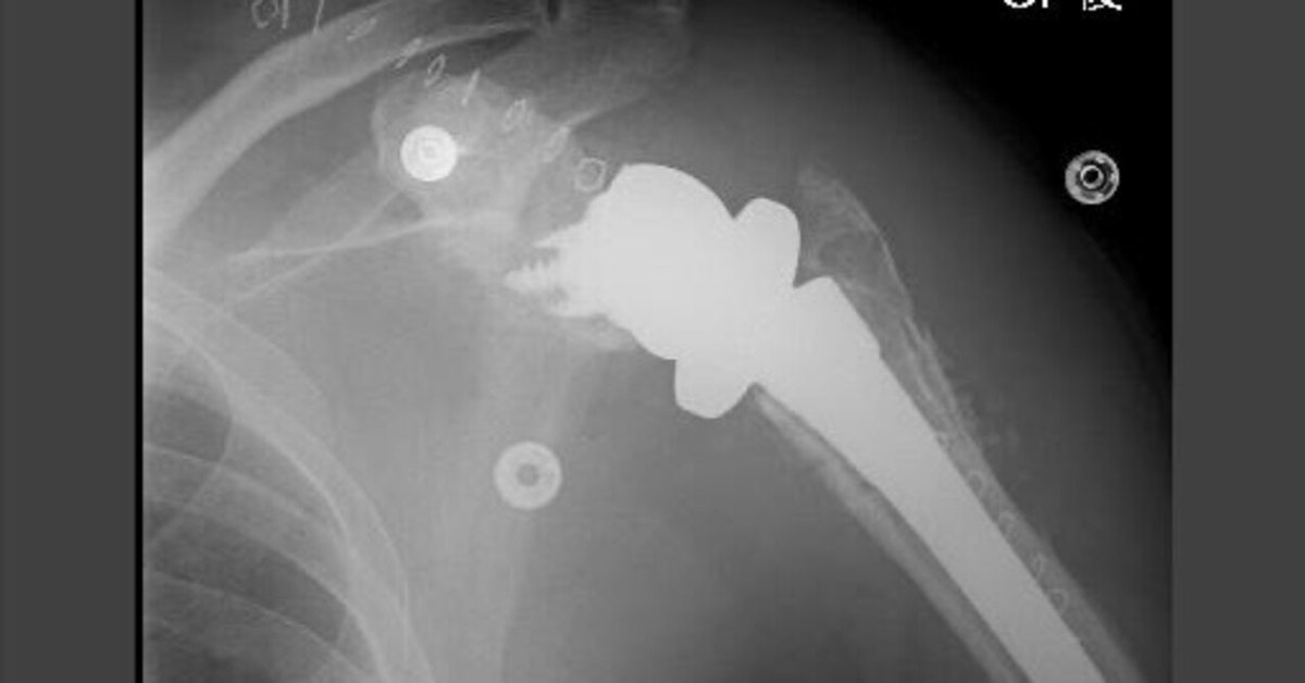 surgical technique 人工肩関節置換術 HHR・TSA・RSA 人工肩関節置換術: HHR・TSA・RSA (整形外科SURGICAL TECHNIQUE