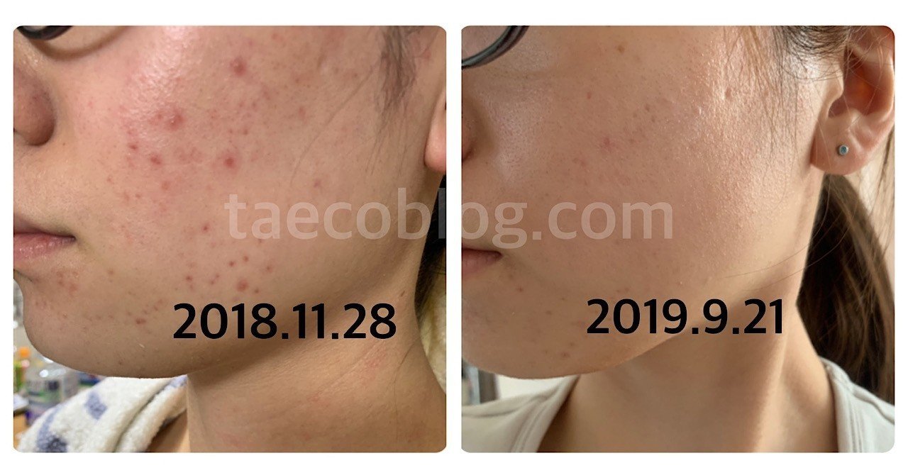 1年以内にニキビを無くす方法 たえ子 Note 1年以内にニキビを無くす方法 たえ子 Note