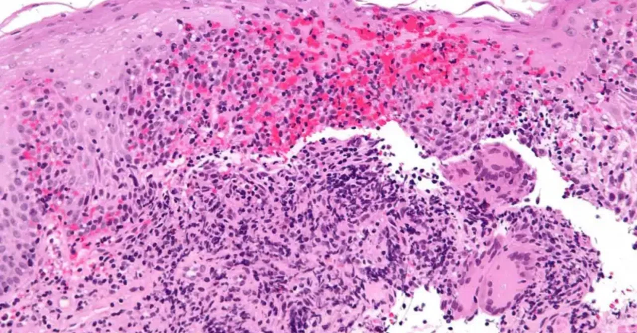 クローン病の新たな原因が発見される：機能不全のミトコンドリアが腸内細菌叢を乱す