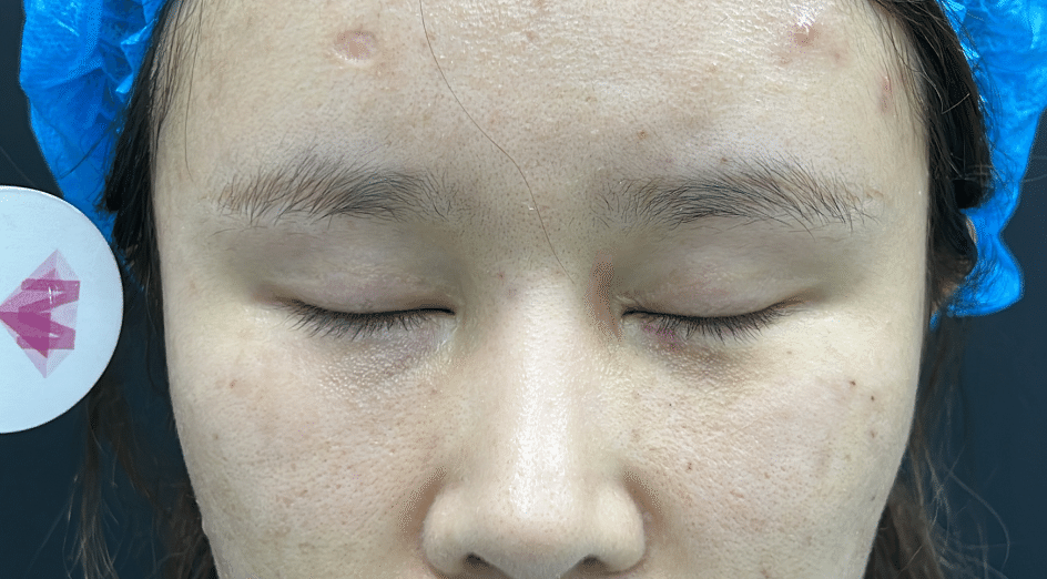 美しい下瞼 🇨🇳整形発信｜Meya_Clinic