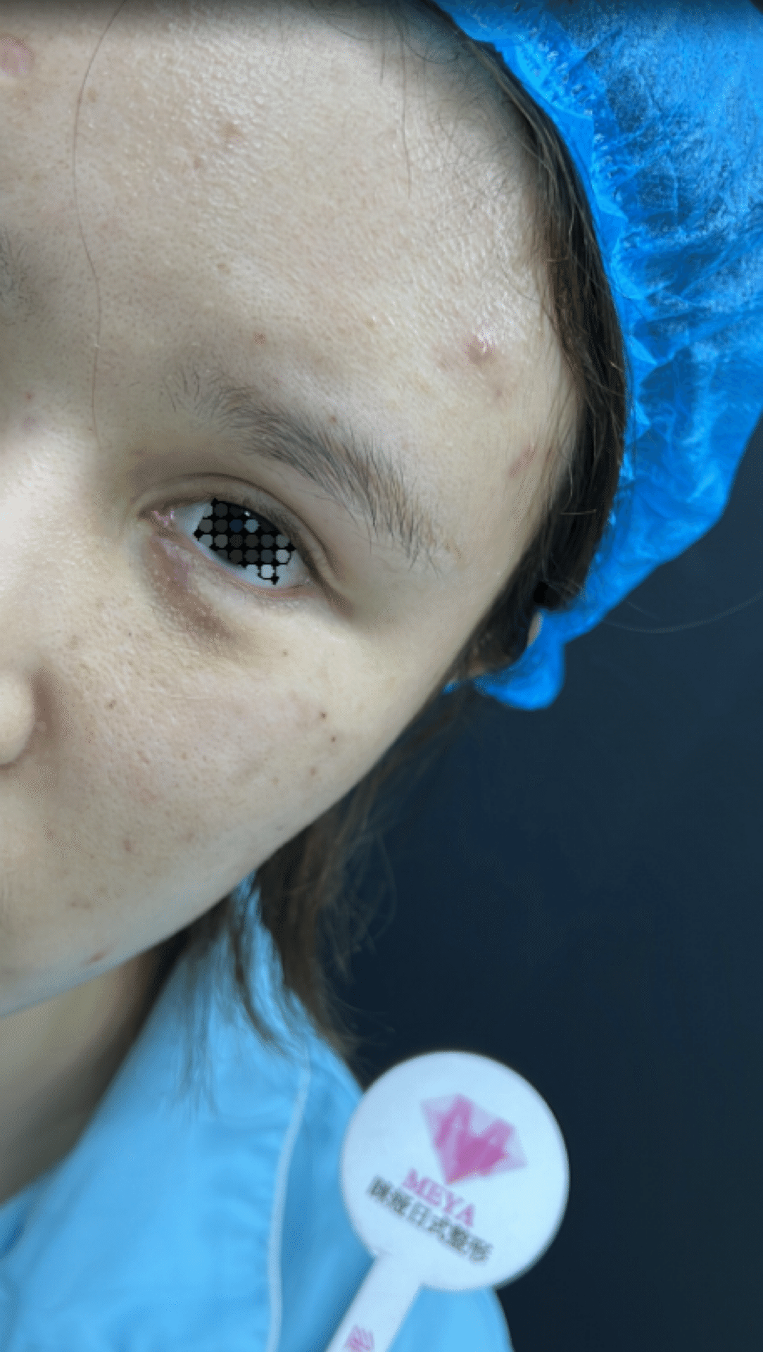 美しい下瞼 🇨🇳整形発信｜Meya_Clinic