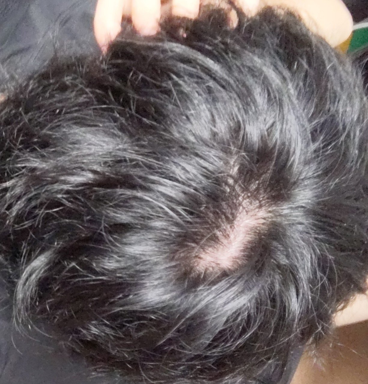 若ハゲというバグとパッチ Kosy Note 若ハゲというバグとパッチ Kosy Note