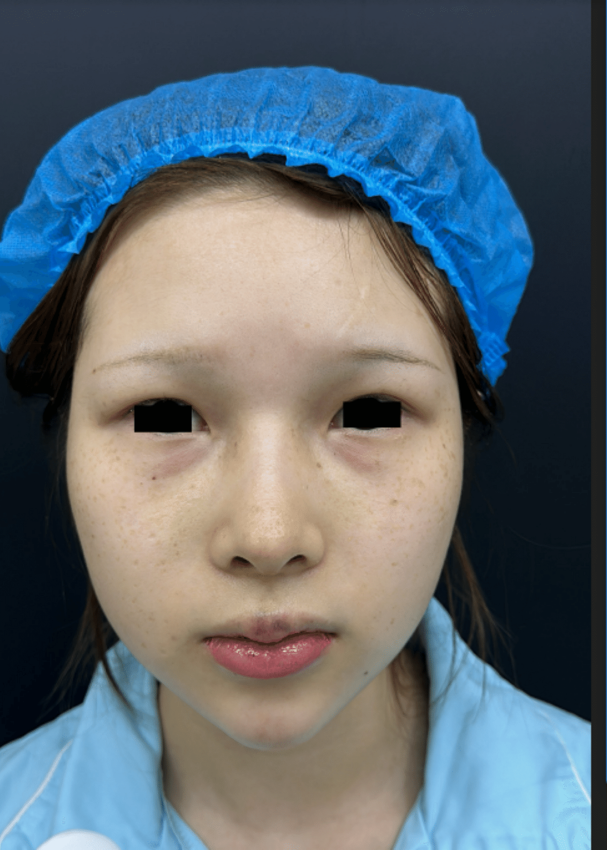 ナチュラルな二重へ🇨🇳整形発信｜Meya_Clinic