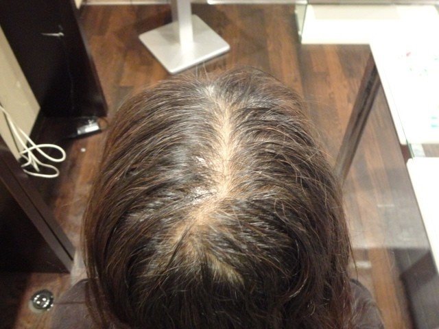 40代女性の薄毛 急に抜け毛が増えて地肌が見える原因と対策とは りょーすけ先生 薄毛 ハゲ Aga治療院 髪ワザchannel Note
