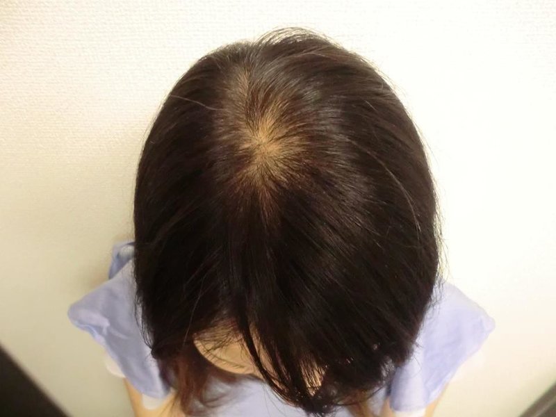 40代女性の薄毛 急に抜け毛が増えて地肌が見える原因と対策とは りょーすけ先生 薄毛 ハゲ Aga治療院 髪ワザchannel Note