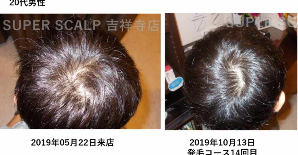 体験談 当店で薄毛を治した代男性発毛レポート 東京 吉祥寺の薄毛 ハゲ Aga治療院 髪ワザchannel Note