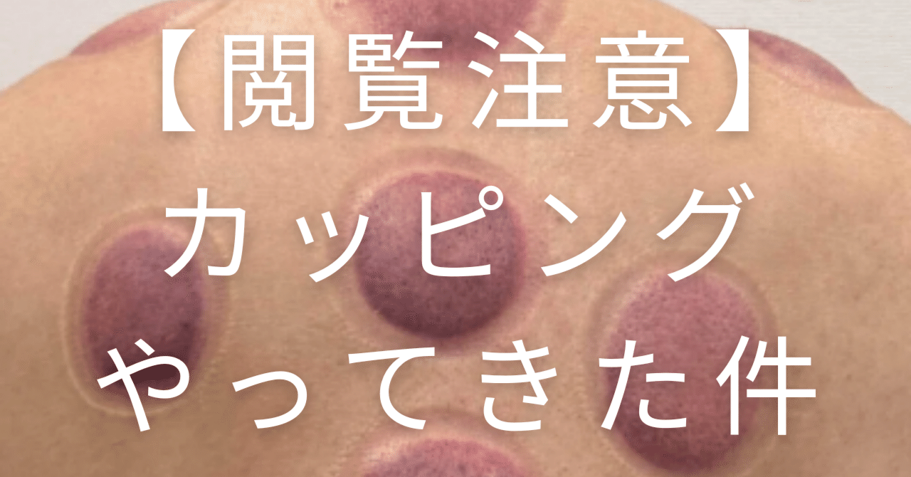 閲覧注意】カッピングやってみたらめっちゃ良かった！！件｜日常