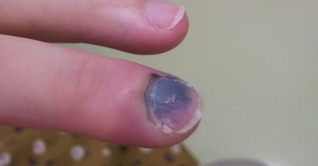 指 挟む 内出血 内出血 指 挟む