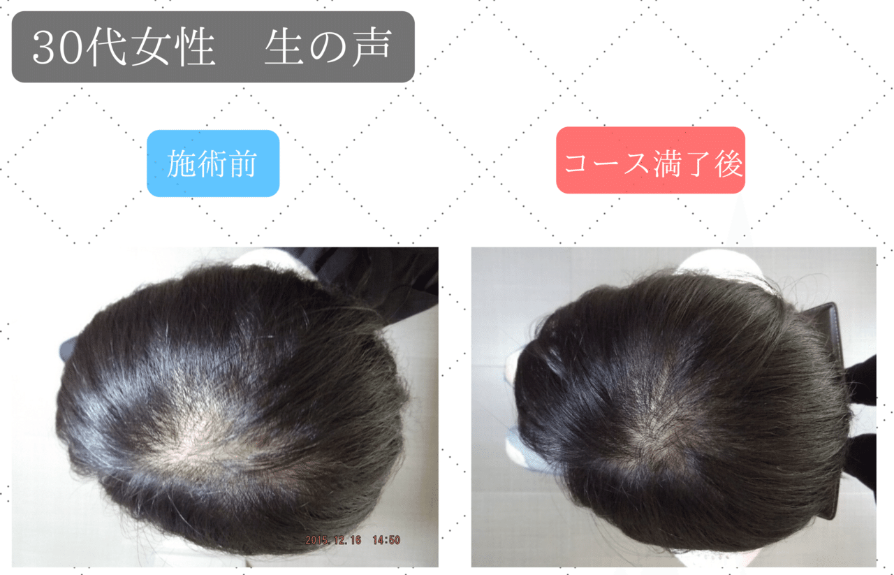 意外に多い 30代女性の薄毛の悩み 原因と対策 りょーすけ先生 髪ワザchannel Note 意外に多い 30代女性の薄毛の悩み 原因と対策 りょーすけ先生 髪ワザchannel Note