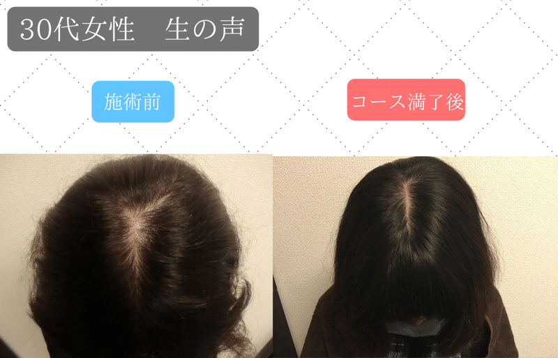 意外に多い 30代女性の薄毛の悩み 原因と対策 りょーすけ先生 髪ワザchannel Note 意外に多い 30代女性の薄毛の悩み 原因と対策 りょーすけ先生 髪ワザchannel Note