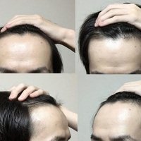 サワさん 若ハゲ 生え際のaga治療記 Note