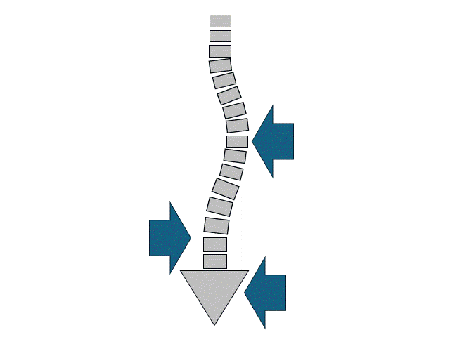 装具学 体幹装具 まとめ 側弯症用装具｜じょんがらPT