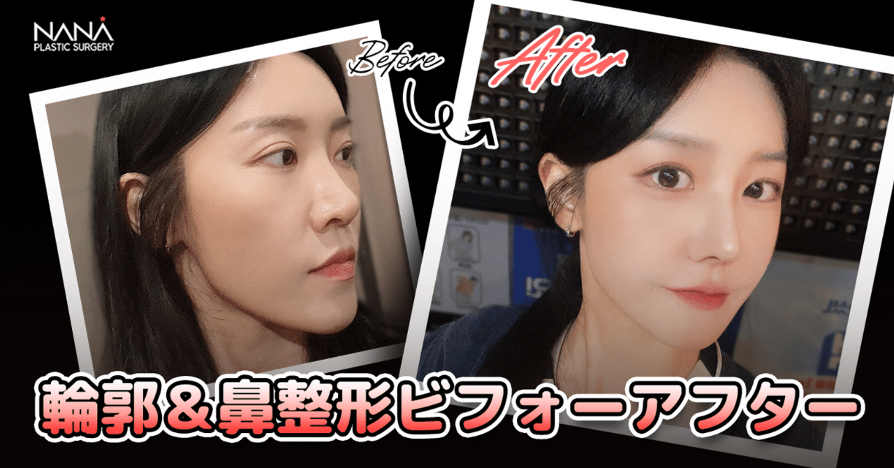 片道3時間かけて当院まで！？輪郭＆鼻整形ビフォーアフター｜韓国整形NANA美容外科, image size:1280x670
