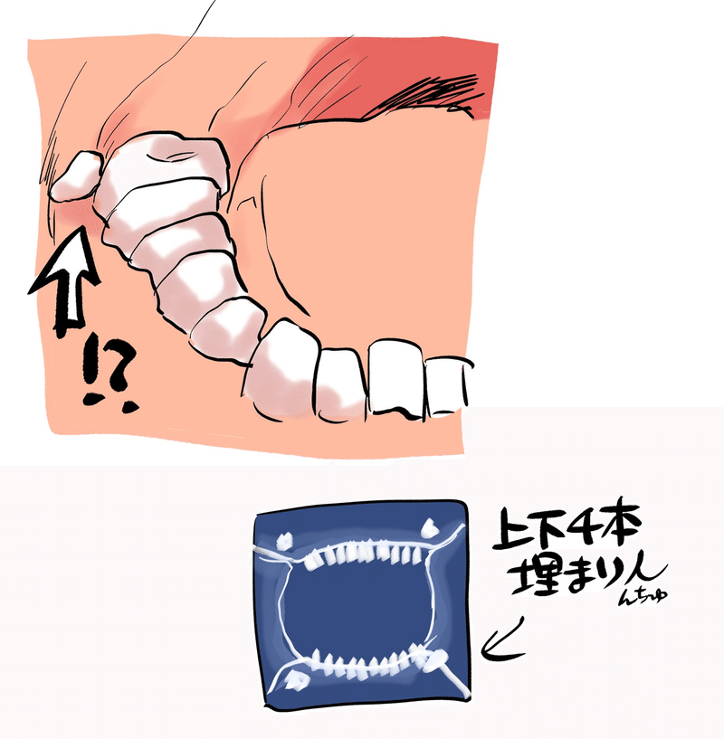 抜歯レポ 親知らずvs俺 肘樹 Note 抜歯レポ 親知らずvs俺 肘樹 Note
