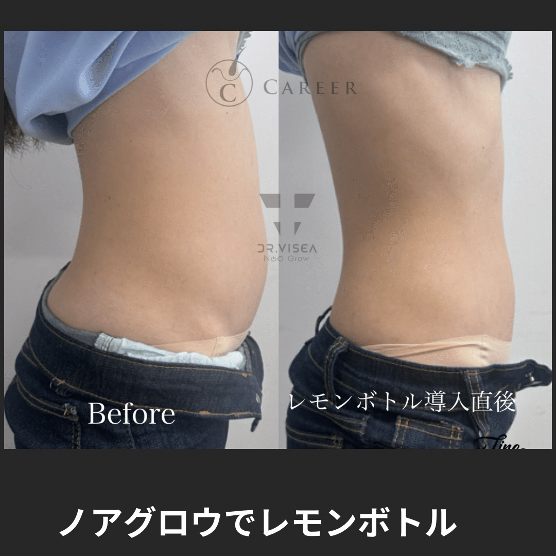 ✨即発送可✨ノアグロウ 同型導入美容機器＋25pinチップ×12個 レモンボトル ✨即発送可✨ノアグロウ 同型導入美容機器＋25pinチップ×12個 レモン