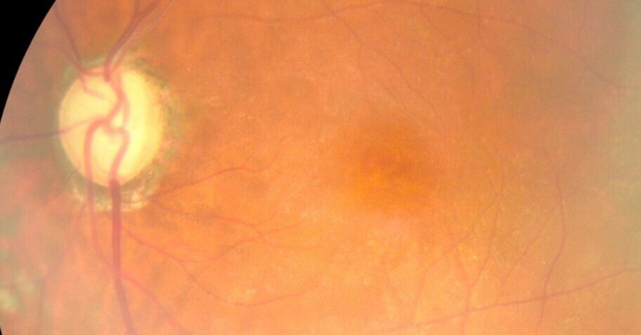 緑内障治療にレーザー治療という選択肢｜岩見久司