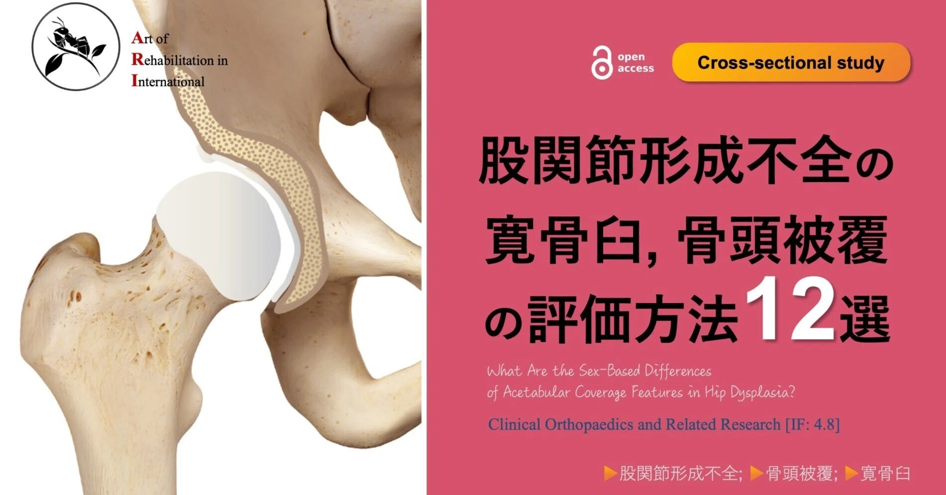 股関節形成不全の寛骨臼・骨頭被覆の評価方法12選｜Super Human | 理学