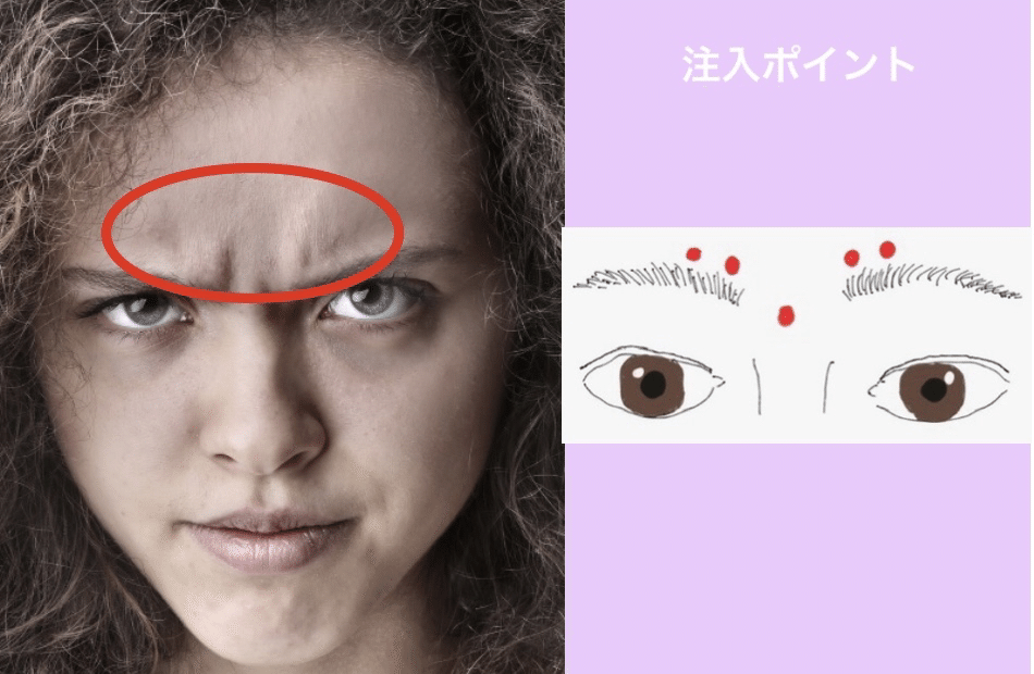 眉間のシワとボトックス注入ポイント