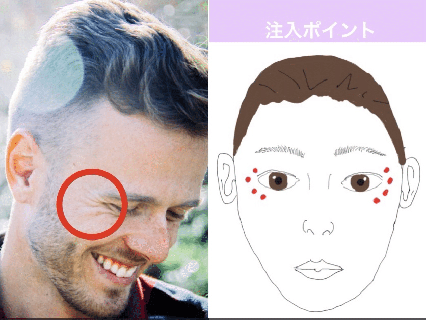 目尻のシワとボトック注入ポイント
