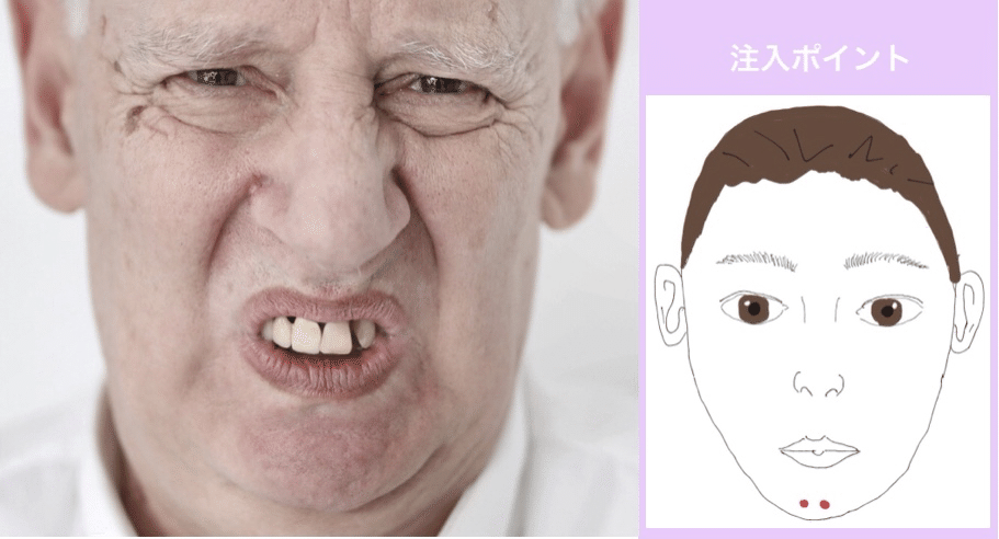 顎のシワとボトックス注入ポイント