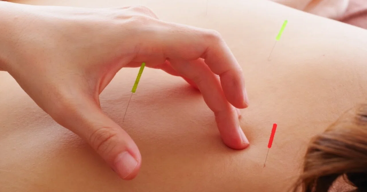 最新｜鍼治療は坐骨神経痛に効果的であることが臨床試験で証明される